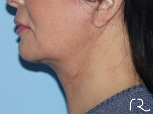 Extended Deep Neck Lift Before & After Gallery - Patient 146377530 - Image 2