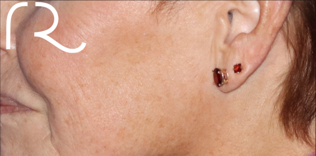 Fractional CO2 Laser Resurfacing Before & After Gallery - Patient 146621396 - Image 1