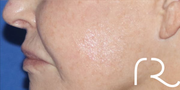 Fractional CO2 Laser Resurfacing Before & After Gallery - Patient 146621396 - Image 2
