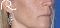 Fractional CO2 Laser Resurfacing Before & After Gallery - Patient 146621397 - Image 1