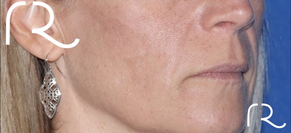 Fractional CO2 Laser Resurfacing Before & After Gallery - Patient 146621397 - Image 1