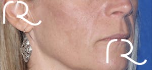 procedure