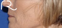 Fractional CO2 Laser Resurfacing Before & After Gallery - Patient 146621398 - Image 1