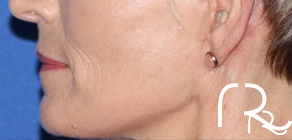Fractional CO2 Laser Resurfacing Before & After Gallery - Patient 146621398 - Image 2