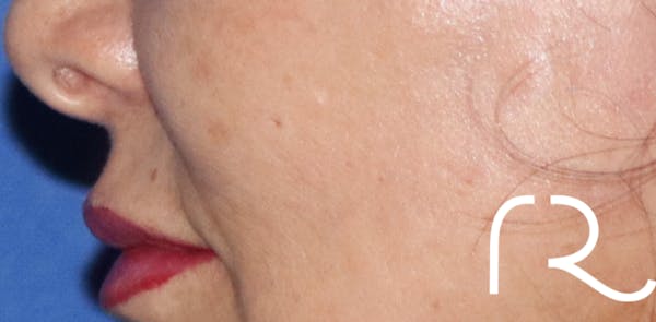 Fractional CO2 Laser Resurfacing Before & After Gallery - Patient 146621399 - Image 2