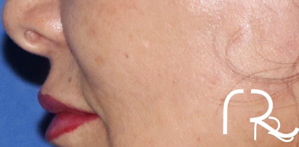 Fractional CO2 Laser Resurfacing Before & After Gallery - Patient 146621399 - Image 2
