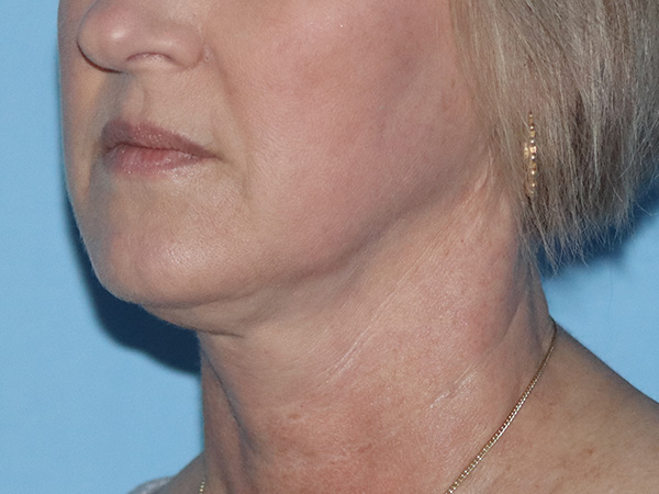 R2 Extended Deep Neck Lift Before & After Gallery - Patient 149260114 - Image 1