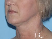 Extended Deep Neck Lift Before & After Gallery - Patient 149260114 - Image 1