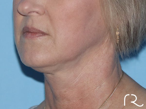 R2 Extended Deep Neck Lift Before & After Gallery - Patient 149260114 - Image 1