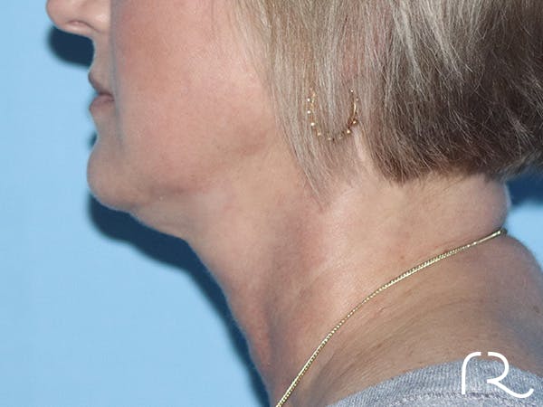 R2 Extended Deep Neck Lift Before & After Gallery - Patient 149260114 - Image 3