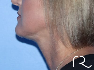 Extended Deep Neck Lift Before & After Gallery - Patient 149260114 - Image 4