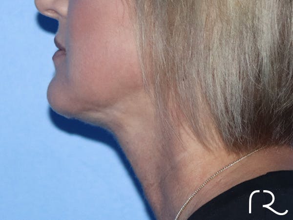 R2 Extended Deep Neck Lift Before & After Gallery - Patient 149260114 - Image 4