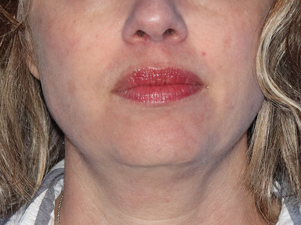R2 Extended Deep Neck Lift Before & After Gallery - Patient 149260122 - Image 3