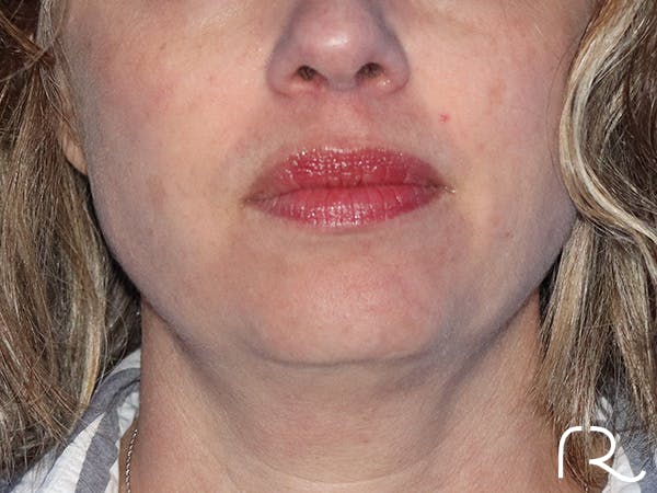 Extended Deep Neck Lift Before & After Gallery - Patient 149260122 - Image 3
