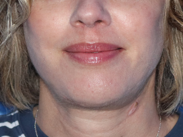 R2 Extended Deep Neck Lift Before & After Gallery - Patient 149260122 - Image 4