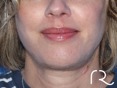 Extended Deep Neck Lift Before & After Gallery - Patient 149260122 - Image 4