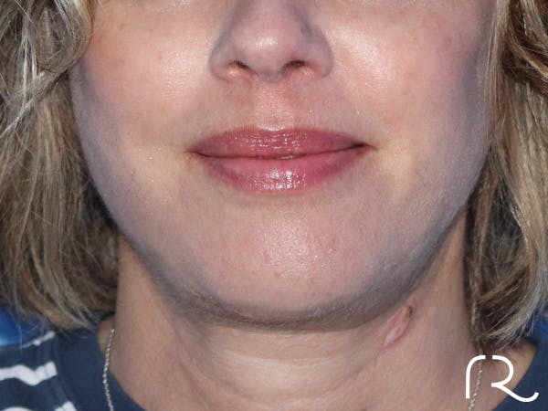 Facelift Before & After Gallery - Patient 149260123 - Image 6
