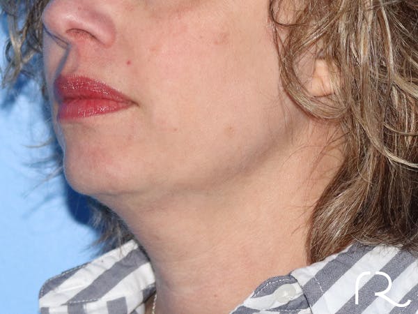 Extended Deep Neck Lift Before & After Gallery - Patient 149260122 - Image 1