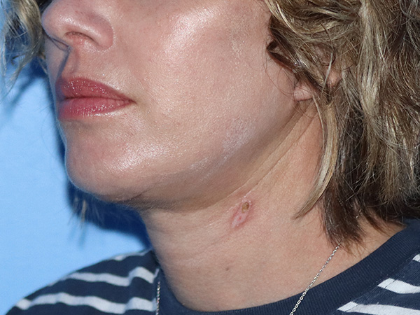 R2 Extended Deep Neck Lift Before & After Gallery - Patient 149260122 - Image 2