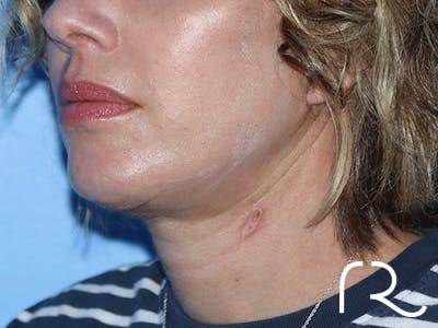 Extended Deep Neck Lift Before & After Gallery - Patient 149260122 - Image 2