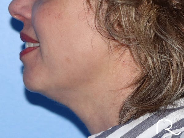Facelift Before & After Gallery - Patient 149260123 - Image 3