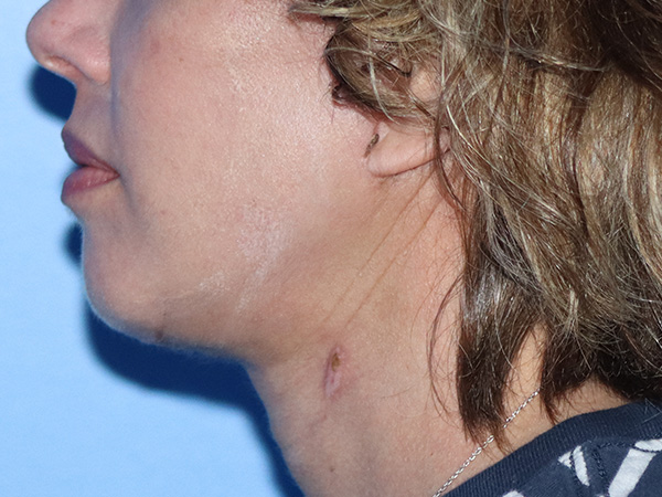 R2 Extended Deep Neck Lift Before & After Gallery - Patient 149260122 - Image 6