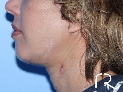 Extended Deep Neck Lift Before & After Gallery - Patient 149260122 - Image 6