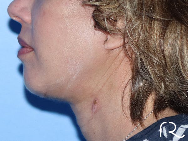 Facelift Before & After Gallery - Patient 149260123 - Image 4