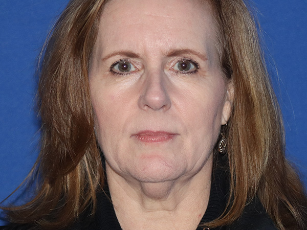 Facelift Before & After Gallery - Patient 149260130 - Image 3