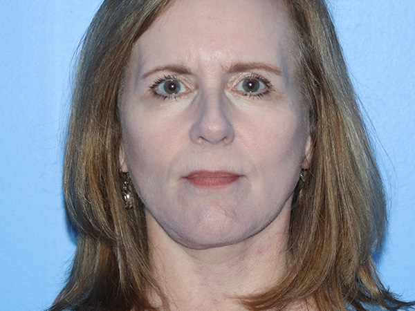 Facelift Before & After Gallery - Patient 149260130 - Image 4