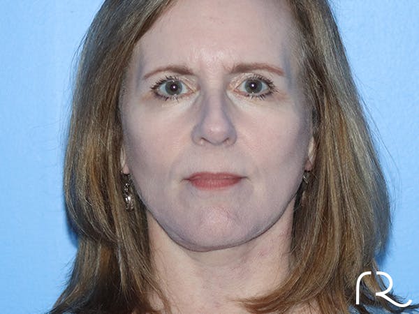 Facelift Before & After Gallery - Patient 149260130 - Image 4