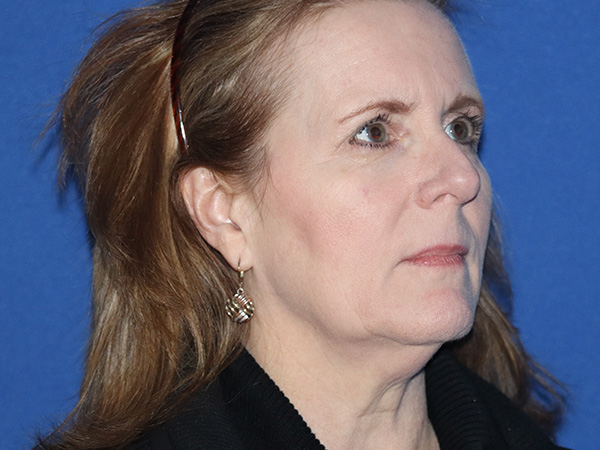 Facelift Before & After Gallery - Patient 149260130 - Image 1