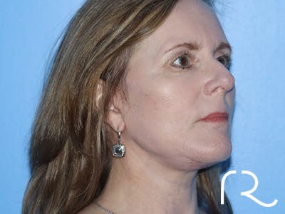 Facelift Before & After Gallery - Patient 149260130 - Image 2