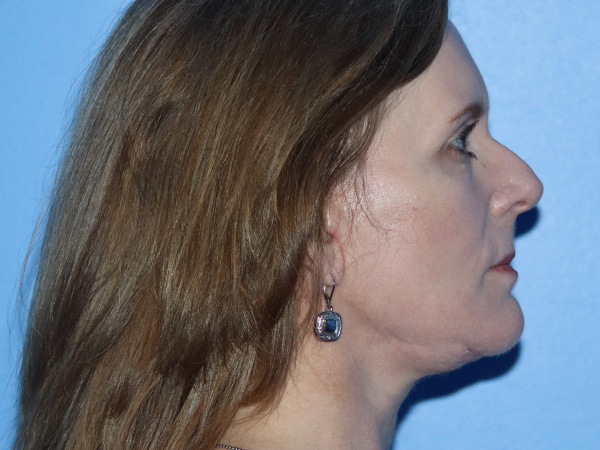Facelift Before & After Gallery - Patient 149260130 - Image 6