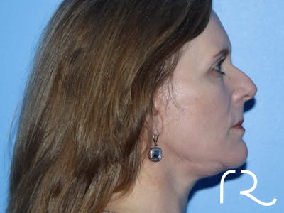 Facelift Before & After Gallery - Patient 149260130 - Image 6
