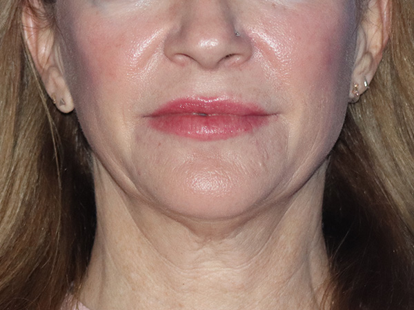 Facelift Before & After Gallery - Patient 149260160 - Image 3