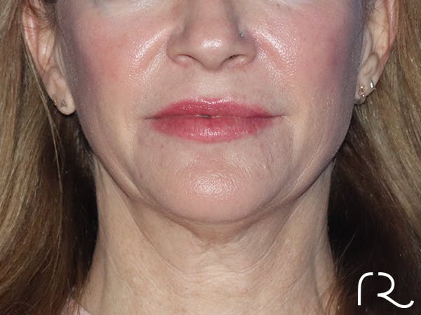 Facelift Before & After Gallery - Patient 149260160 - Image 3