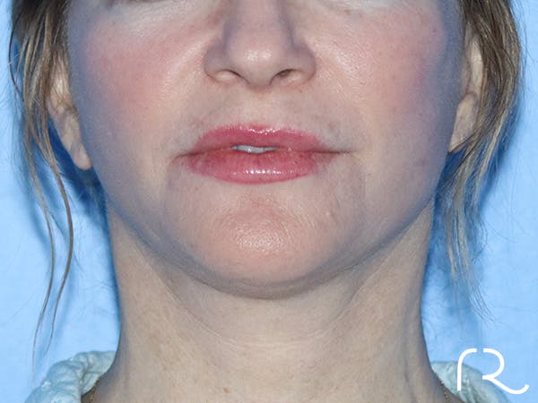 Neck Liposuction  Before & After Gallery - Patient 149260162 - Image 6