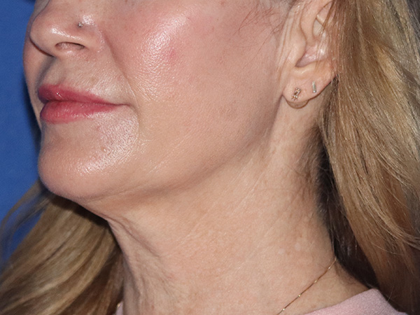 Neck Lift Before & After Gallery - Patient 149260161 - Image 1