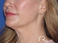 Neck Liposuction  Before & After Gallery - Patient 149260162 - Image 1