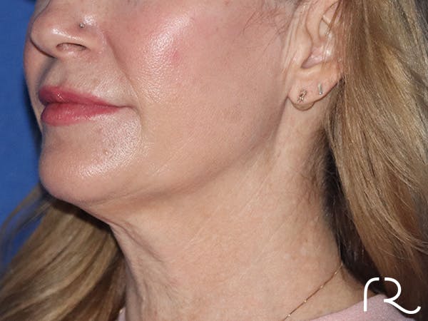 Neck Liposuction  Before & After Gallery - Patient 149260162 - Image 1