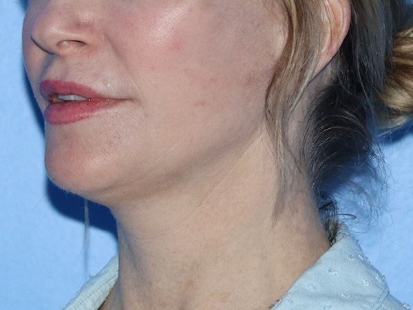 Facelift Before & After Gallery - Patient 149260160 - Image 2