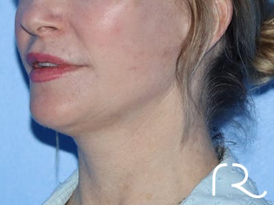 Facelift Before & After Gallery - Patient 149260160 - Image 2