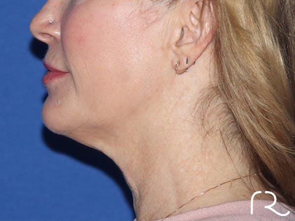 Neck Lift Before & After Gallery - Patient 149260161 - Image 3