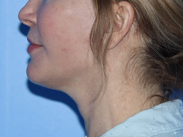 Facelift Before & After Gallery - Patient 149260160 - Image 6