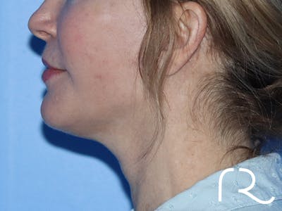 Neck Liposuction  Before & After Gallery - Patient 149260162 - Image 4