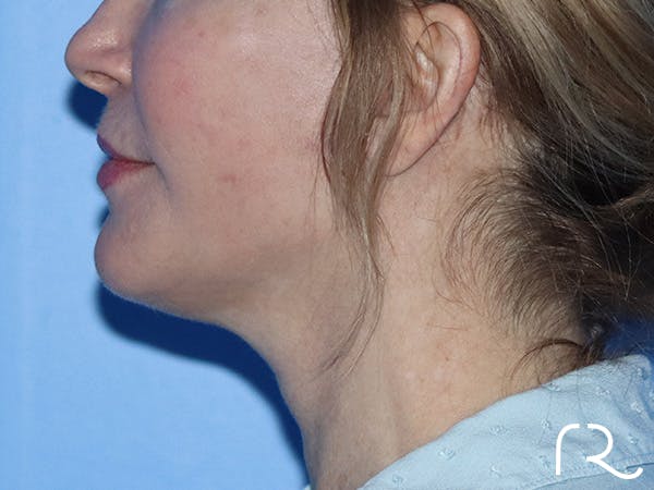 Neck Lift Before & After Gallery - Patient 149260161 - Image 4