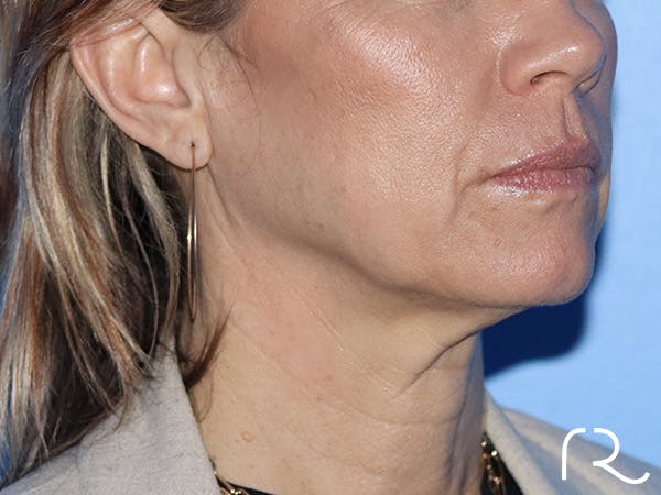 Facelift Before & After Gallery - Patient 149260164 - Image 1