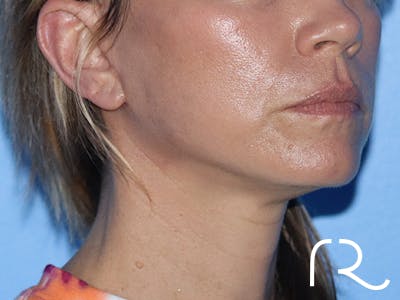 Facelift Before & After Gallery - Patient 149260164 - Image 2