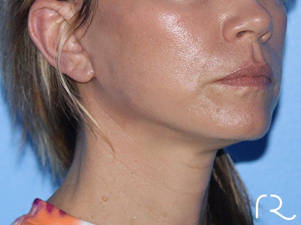 Facelift Before & After Gallery - Patient 149260164 - Image 2
